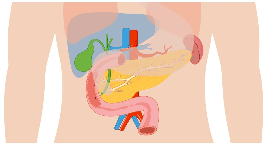 Zollinger-Ellison syndrome